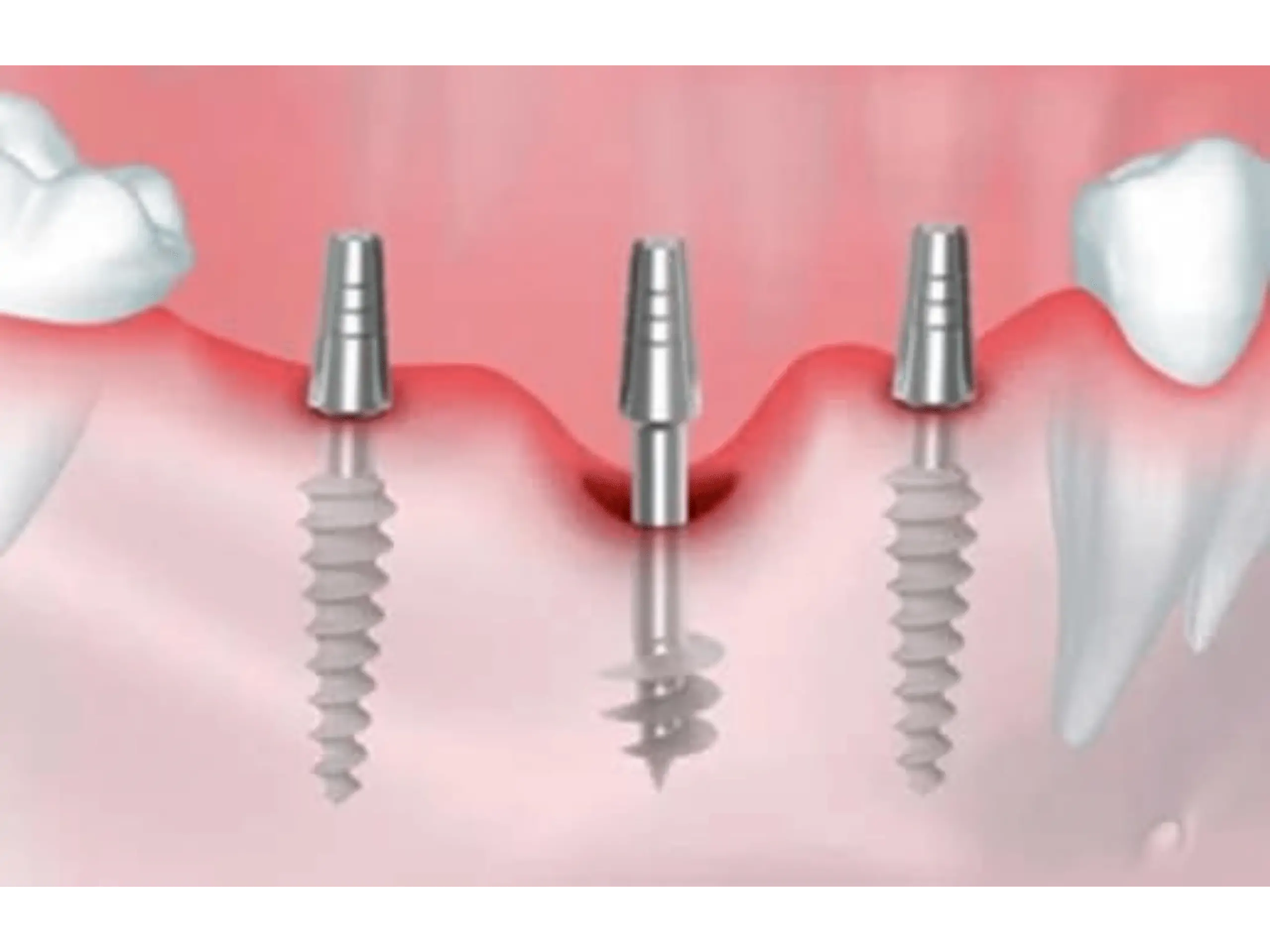 types of dental implants and cost